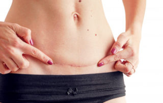 plano-vientre-mujer-cicatriz-cesarea-hipopresivos-madrid-barrio de salamnca